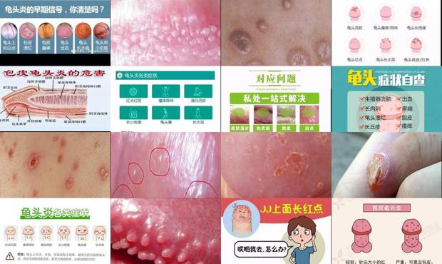 汕头龟头炎症状