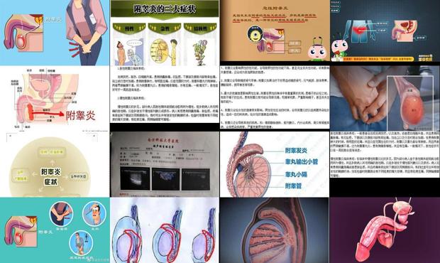汕头附睾炎症状