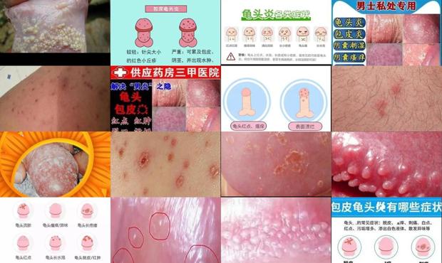 汕头男性龟头炎症状图片怎么样
