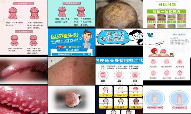 汕头包皮炎症状对照图片