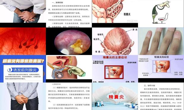 汕头精囊炎症状表现有哪些