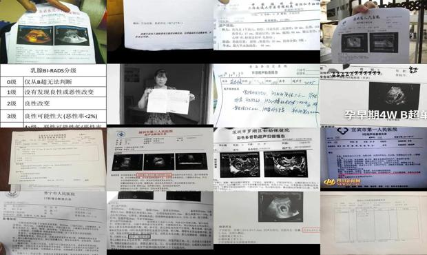 汕头b超检查报告单