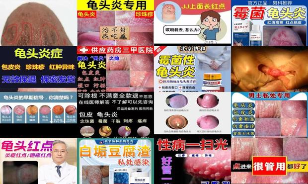 汕头白色念珠菌龟头炎症状