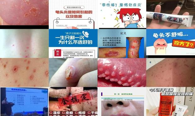 汕头龟头皮炎症状