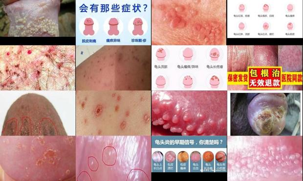 汕头鬼头炎症