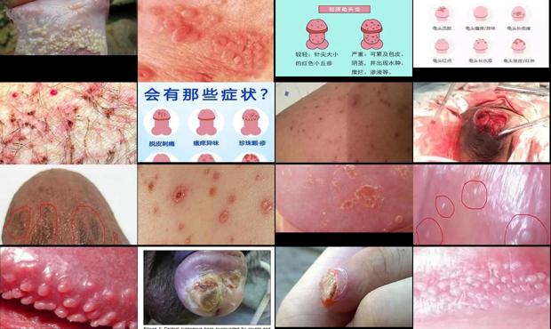 汕头龟头炎症图片