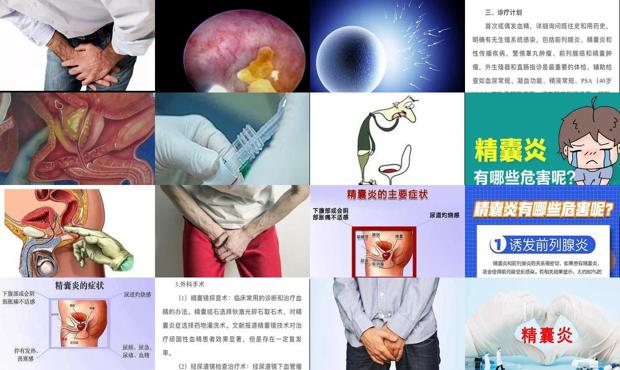 汕头精囊炎症状