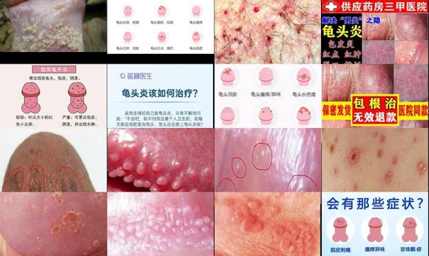 汕头龟头有炎症
