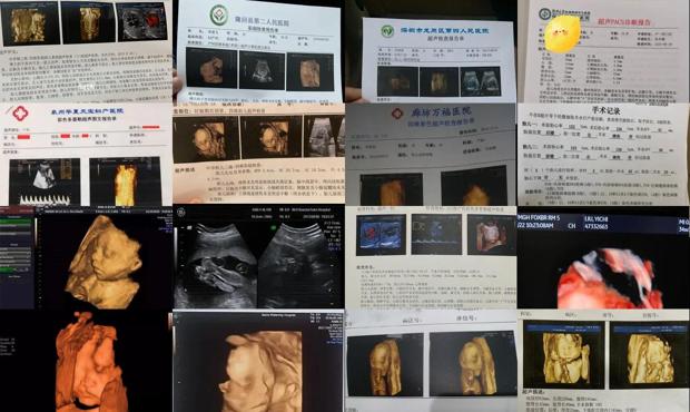 汕头医生不建议做四维彩超