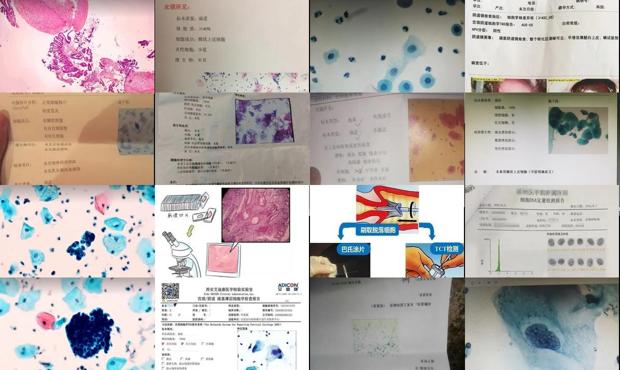 汕头宫颈细胞学检查