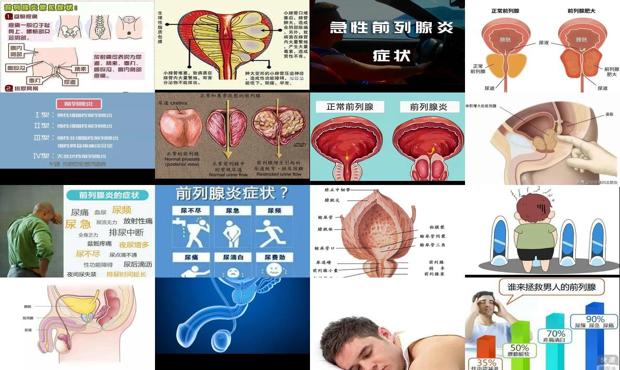 汕头急性前列腺炎症状