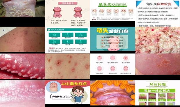 汕头龟头炎症状对照图片