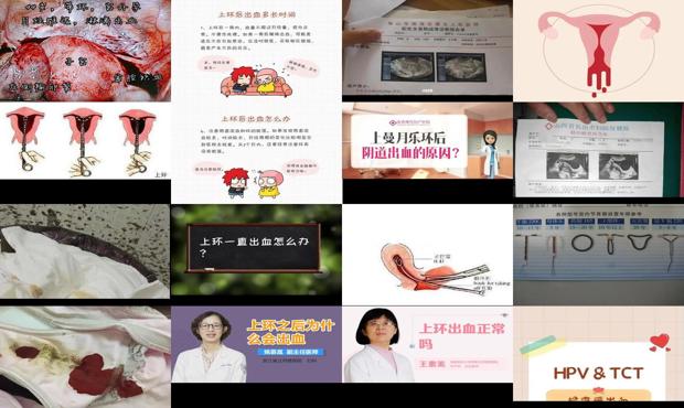汕头上环后出血正常吗