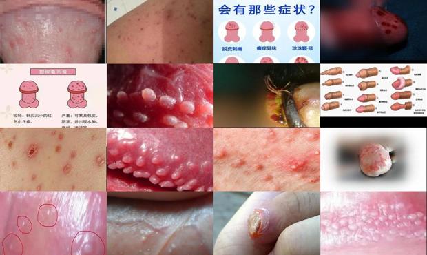 汕头包皮炎症图片