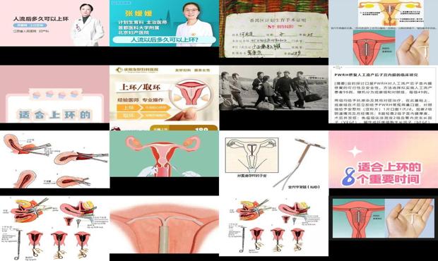汕头流产后可以马上上环吗