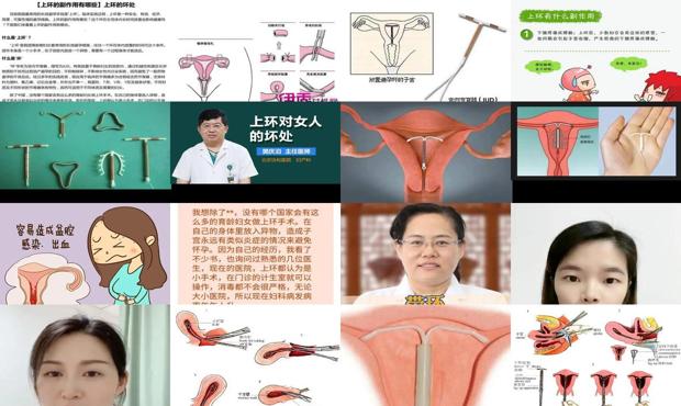 汕头上环对女人有什么危害