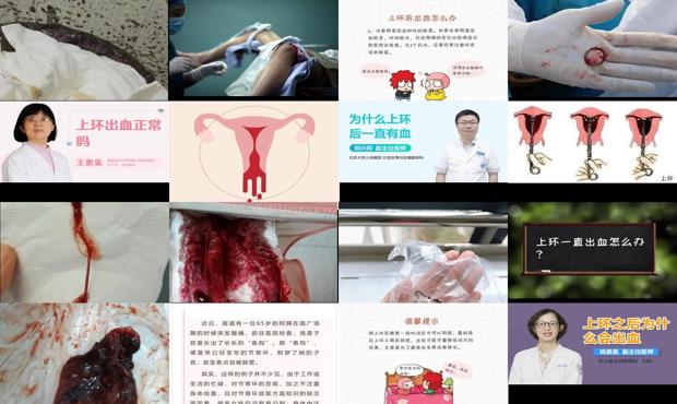 汕头上环后出血