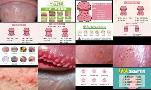 汕头包皮龟头炎症状