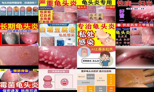 汕头念球菌龟头炎症状