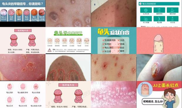 汕头龟头炎症状图片
