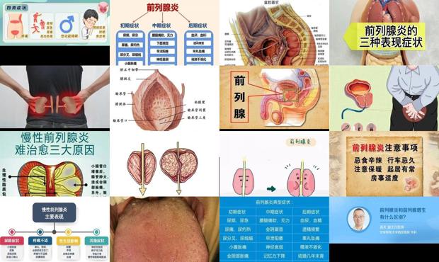 汕头前列腺炎症状图片