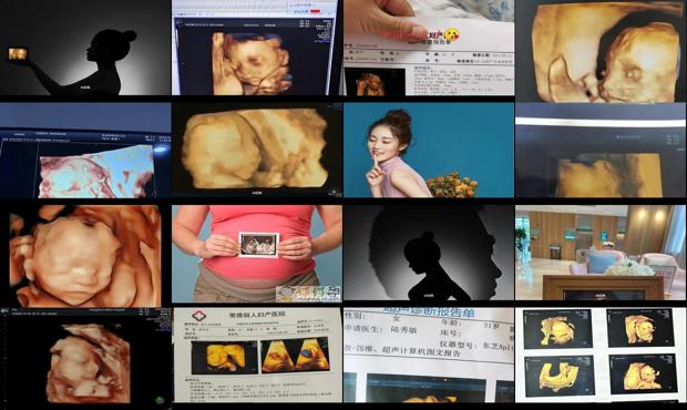 汕头孕妇照四维彩超
