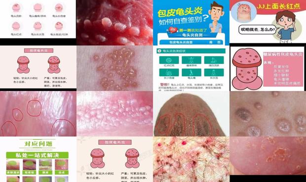 汕头龟头炎症状对照