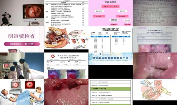 汕头阴倒镜检查的费用