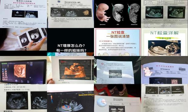 汕头nt检查是什么