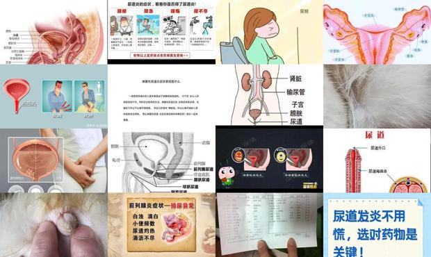 汕头尿道发炎症状