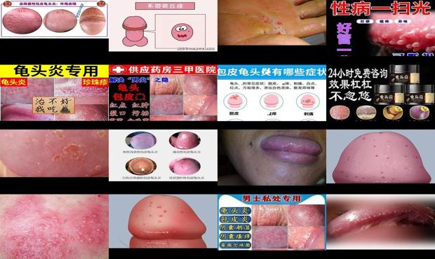 汕头白念珠菌性龟头炎症状