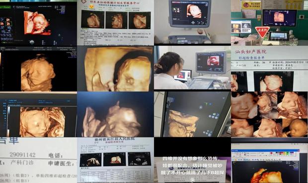 汕头孕做四维彩超
