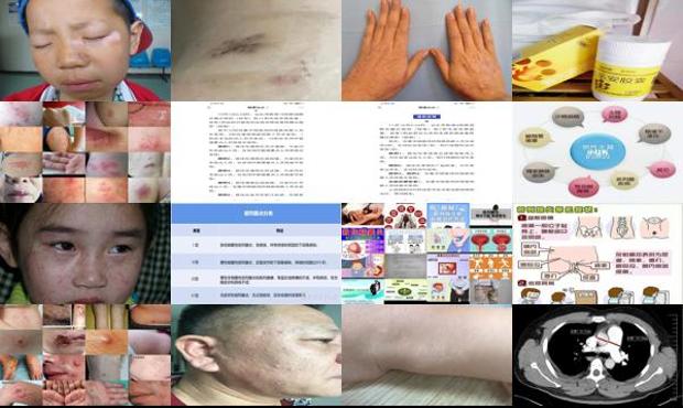 汕头前腺炎症状