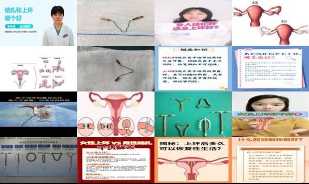 汕头上环好还是结扎好