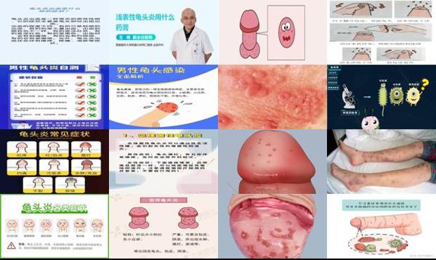 汕头细菌性龟头炎症状